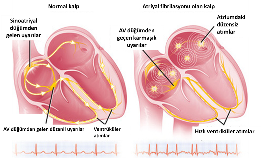 Aritmi Nedir?